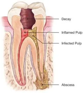 A tooth is shown with the root canal being removed.